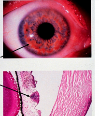Lisch nodules: pigmented hamartomas in iris