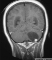 Typically in the cerebellum
Symptoms usually relate to increased intracranial pressure
MRI shows well-defined contrast enhancing cystic mass with mural nodule

Treat with surgical resection