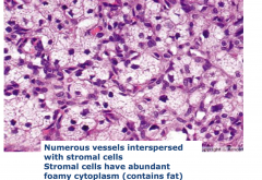 Hemangioblastoma
- numerous vessel interspersed with stomal cells
- Stromal cells have abundant foamy cytoplasm