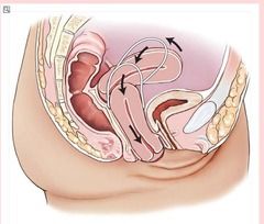 hysteroptosis= uterine prolapse