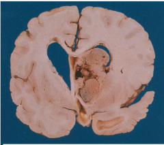 Likely to cause obstructive hydrocephalus
Exophytic solid well-defined mass  arising in the wall of lateral ventricle