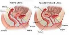 retroflexion of uterus
tử cung ngả ra sau