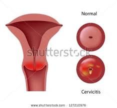 cervicitis
viêm cổ tử cung