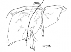 Line drawn from the gallbladder to a point just to the left of the IVC, which transects the liver into the right and left lobes


 