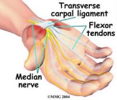 Image.  Carpal tunnel syndrome is pain, tingling, and numbness in the hand (but not the pinky) that is a result of pressure on the median nerve.