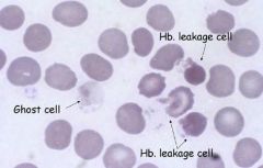 1) ↓ RBC count /  ↓ HCT /  ↓ Hgb (Anemia)
2) ↑ MCH and ↑ MCHC (Falsely raised from hemoglobinemia)
3) Indications of nephropathy
4) Ghost cells on blood smear