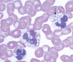 Marked toxic change in neutrophils is due to bacterial toxins and can indicate sepsis.
We may see dohle bodies, cytoplasmic basophilia, vacuolization, persistent purple granules, or large neutrophils.