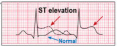 Typical chest pain
Electrocardiographic changes of ST elevation (whole heart function has change and heart struggling to function properly)

Myocardial enzyme elevation of creatine kinase (CK-MG) and troponin