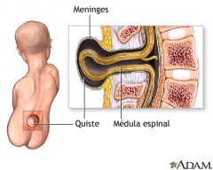 folate reduces risk
lumbosacral

lower sacral -- bowel/bladder incontinence, saddle anesthesia