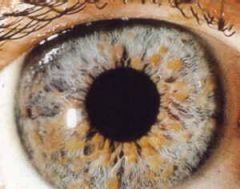aut dom

2 criteria needed:
--5 cafe-au-lait >5mm
--axillar/inguinal freckling
-->2 iris Lisch nodules
-->2 neurofibromas or one plexiform neurofibroma
--osseous lesions (thinning of bone)
optic gliomas
