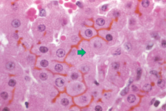Given that this is liver tissue what are the brown lines called and where are they accumulating?