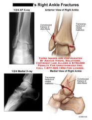 Anterposterior or lateral 


-NOT oblique and lateral 


-tri malleolus fracture includes fracture of both malleoli and the posterior rim of the tibia. The anterior posterior view of the ankle demonstrate the distal tibia and fibula, including t...