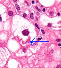 eosinophilic inclusions (Curly rope appearance)