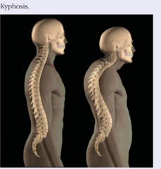 Kyphosis (an increased curve of the thoracic spine) is common in older clients (see Abnormal Findings 19-1 on page 393). It results from a loss of lung resiliency and a loss of skeletal muscle. It may be a normal finding.