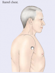 Barrel-chest configuration results in a more horizontal position of the ribs and costal angle of more than 90 degrees. This often results from long-standing emphysema.