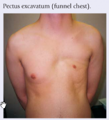 Pectus excavatum is a markedly sunken ster-num and adjacent cartilages (often referred to as funnel chest). It is a congenital malfor-mation that seldom causes symptoms other than self-consciousness. 