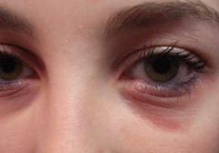 "Allergic shiners" - dark circles around the eyes related to vasodilation or nasal congestion
 
Dennie-Morgan lines (prominent creases below the inferior eyelid) are also associated with allergic rhinitis