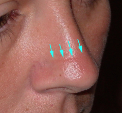 "Nasal crease" - horizontal crease across the lower half of the bridge of the nose caused by repeated upward rubbing of the tip of the nose by the palm of the hand ("allergic salute")
