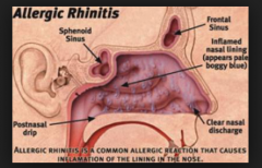- Swollen (boggy)
- Pale bluish-gray color
- Thin and watery secretions (vs. thick/purulent is usually associated with sinusitis), however thick, purulent, colored mucus may be in allergic rhinitis