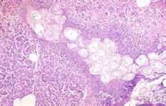 Describe what is seen in this histologic slide and what disease is most likely causing this. 



What would be seen on a CBC with this disease?