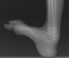 Hx:6yoB w/spina bifida presents to your clinic w/a progressive foot deformity. He can walk independently and ankle DF and toe ext demonstrate full strength. He has a bulky, hypertrophied heel pad, but no open ulceration. Foot Xrays Fig A. What mye...