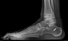 This patient has a L5 level myelomeningocele as he is an ambulator with talipes calcaneus demonstrated on the radiograph. L1 level myelomeningocele patients have externally rotated and flexed hips, equinovarus feet, require a HKAFO, and cannot fun...