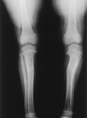 Surgery is indicated if varus secondary to Blount's dz persists at the age of 4 or if bracing fails in 2-3 year olds p/ 12 mths. Correction is achieved surgically with a proximal tibial realignment osteotomy. Answer 5 is incorrect because closing ...