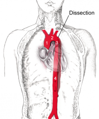 The Aorta is the main artery of the body. It supplies large amounts of oxygenated blood to the rest of the body with a high pressure. It passes over the L ventricle and runs down in front of the backbone.