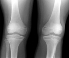 Hx:7yo B c/o worsening L knee pain x 2 wks. He has been unable to bear weight through the L LE x 24 hrs. The knee & lower leg are warm and tender to palpation. t= 100.9 deg, CRP is 11 mg/dL (nml <1). A xray Fig A. A jnt aspiration yields 2 mL's of...