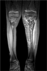 this patient is presenting with signs of infection, but a nl xrays & knee aspiration. Osteomyelitis should be suspected, and MRI is the most appropriate next step. pt is too ill to observ, and a dx must be made before ABX are started. MRI is also ...