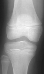 Hx:10-yo B c/o 2 days of worsening R knee pain, unable to ambulate on the leg since waking up this morning, denies any recent trauma to the leg. PE is notable for focal tenderness over the distal femur w/out a palpable fluid collection, ESR is 68 ...