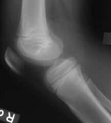 child's clinical presentation is consistent w/ an acute infection. xrays do not show osseous changes for 7-10 days, but soft tissue swelling may be noticeable. The knee aspiration is NOT consistent with septic arthritis of the knee. The child most...