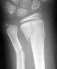 Hx:8-yo B fell while riding his bike & landed on his outstretched arm. xrays are provided in Fig A. Which of the following increases the risk of displacement following CR & casting?  1-LAC immobilization; 2-SAC immobilization; 3-Cast index > 0.85;...