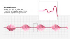 Chyne-stockes breathing

central sleep apnea

http://www.youtube.com/watch?v=VkuxP7iChYY