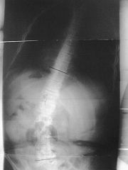 Hx: 9yo B w/Duchenne muscular dystrophy has increasing difficulty with ambulation, denies back pain, difficulty sitting in a chair, or shortness of breath. Annual screening spine xrays demonstrate a 20 deg thoracolumbar curve. Which of the followi...