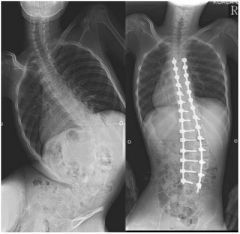 Duchenne muscular dystrophy is a X-linked recessive disease of dystrophin causing progressive proximal muscle wasting. Scoliosis of Duchenne muscular dystrophy behaves similar to neuromuscular curves. Rapid progression of the curve (up to 2 degree...