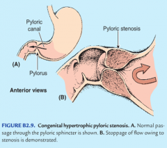 hypertrophy of the pyloric sphincter, inhibiting gastric emptying w/ non-bile stained, severe "projectile" vomiting, presenting as 4-8 wks in infants 
(secondary dilatation of stomach)