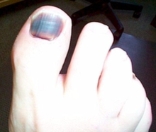 Subungual hematoma:
- bleeding underneath toe nails
- common in distance running
- secondary to deceleration
- toe hits end of toe box and causes disruption in nail/toe bed
- can be acute (drop a weight, step on)