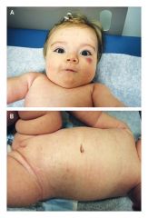 הוצגה תינוקת בת שלושה חודשים עם נגע מבודד בלחי ותפרחת מפושטת על פני מרבית הגוף. ללא תסמינים. הנגע בפנים הופיע קודם. ללא תלונות כלל.