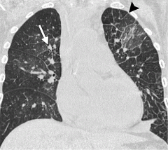 Pulmonary edema is the most common noninfectious complication in the first weeks after HSCT, with a peak incidence in the 2nd to 3rd week after transplant. Pulmonary edema affects autologous and allogeneic transplant recipients equally. The etiolo...