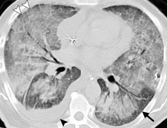 Multilobar pulmonary opacities seen at imaging and a progressively bloodier return at BAL in the absence of infection very early post-HSCT (median 12-15 days)

A finding of >20% of hemosiderin-laden macrophages can be suggestive (BUT NOT SPECIFI...