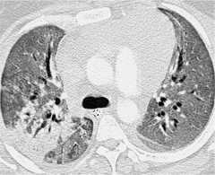 The imaging appearance of PERDS may be indistinguishable from that of pulmonary edema and may mimic that of acute respiratory distress syndrome when there are extensive ground-glass opacities. The absence of cardiac enlargement or other clinical f...