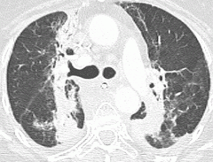 A 67-year-old woman who initially presented with fever and acute respiratory failure after HSCT for diffuse large B-cell non-Hodgkin lymphoma.  This resolved after steroids given and BAL negative revealing above image.  What's the likely diagnosis?