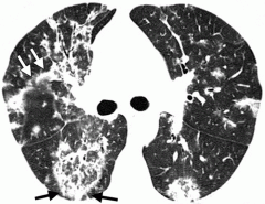 Organizing Pneumonia
 -  It is a well-known late complication of HSCT, but its incidence is low (2%–10%)
 - Allo>Auto

Although pathology is the standard of reference for diagnosis, characteristic HRCT features in the appropriate clinical se...