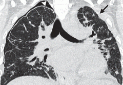 A rare described entity characterized by fibrotic thickening of the pleura and fibroelastosis of the subpleural parenchyma that affects predominantly the upper lobes.  Often 2-16 years after transplant.

Coronal HRCT image shows smooth thickenin...