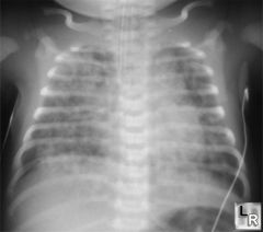 tachypnea, hypoxia, hypercapnia
meconium in the tracheal of amniotic fluid combined with symptoms of respiratory distress and a CXR that reveals a pattern of diffuse infiltrates with hyperinflation
10% of infants with severe disease will develop p...