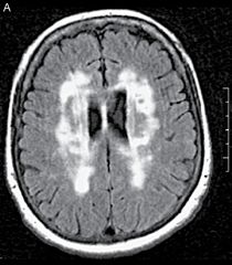 Extensive white matter T2-signal hyperintensities known as leukoaraiosis, which is particularly prominent in Binswanger disease