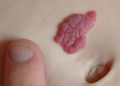 Name this disease, who gets it, and what you would to to treat it. Why?