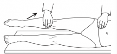 Pain elicited by extending the hip with the knee in full extension, seen with appendicitis and psoas inflammation 