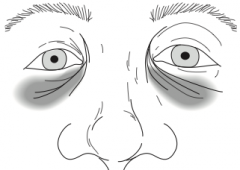 Bilateral black eyes as a result of basilar skull fracture 